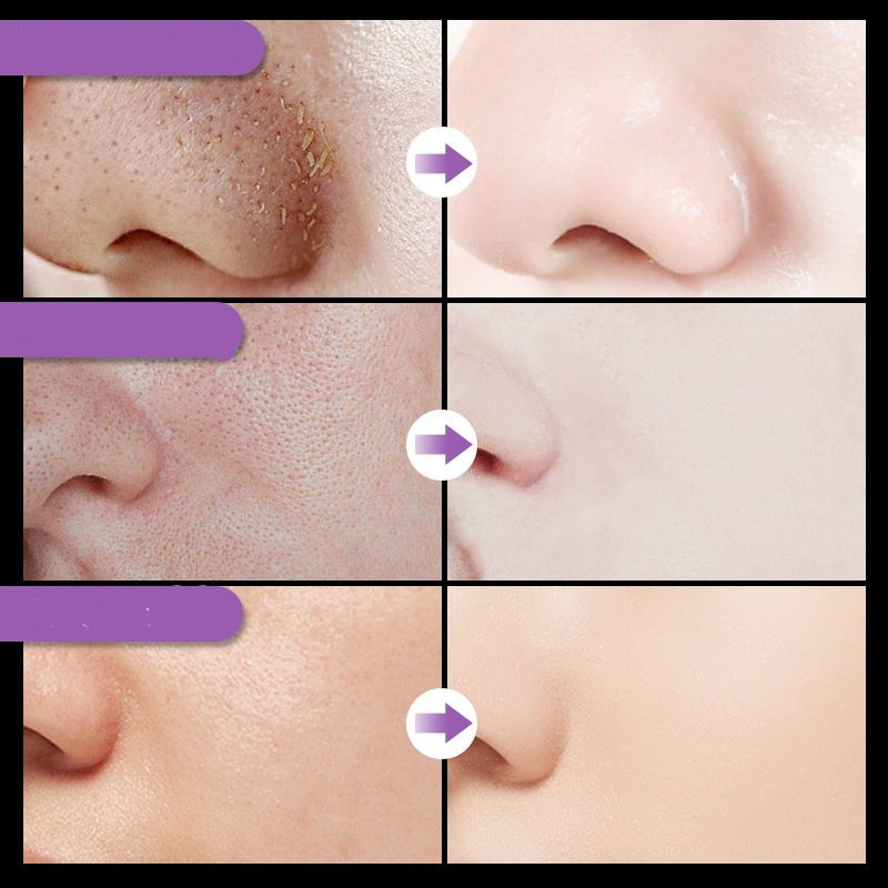 Black Máscara Facial - Removedora de Cravos